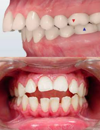 speech-learning-buck teeth-thumb sucking